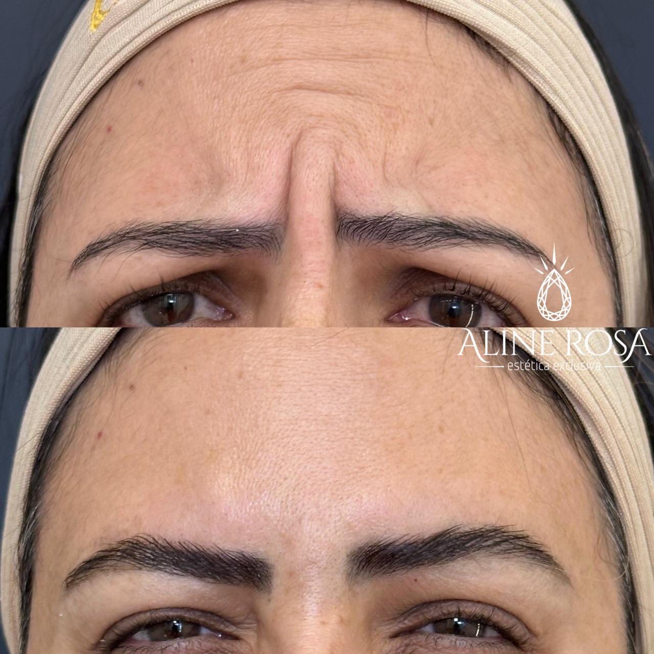 Botox Feminino